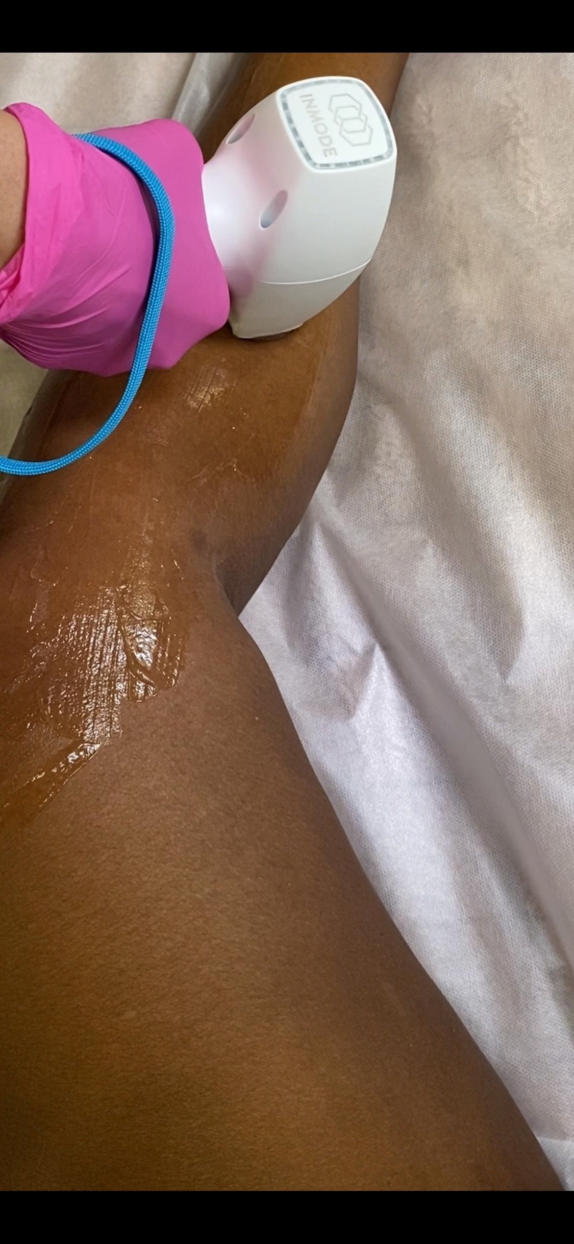 How Many Sessions for Laser Hair Removal?