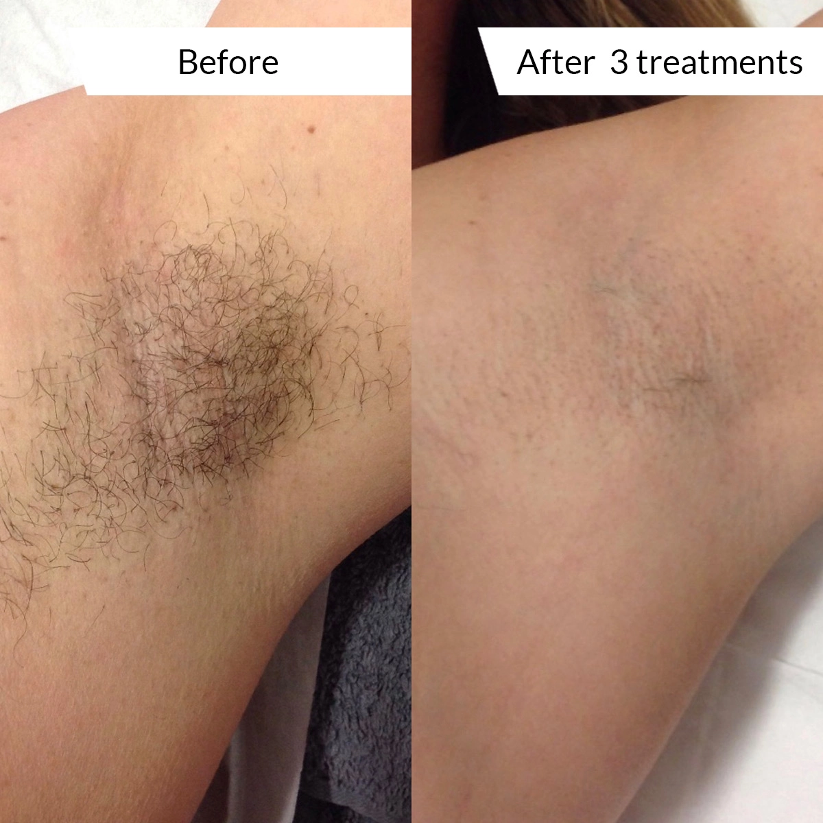 BM-Laser-Hair-Removal-Before-After-3-Treatments