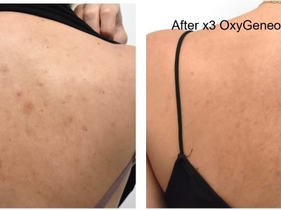 Balance Back Treatment #2