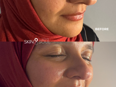 Before and After horizontal (Instagram Post (45)-microchanneling