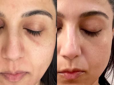 Before and after Vertical - 3
