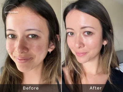 Client3-Ashten_Skincare_microneedling_Before-After-nogreen_copy_480x480