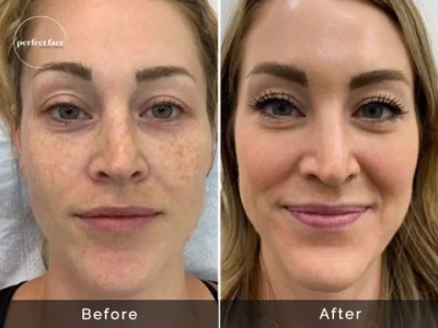 Client6-Zoe_Skincare_microneedling_Before-After-nogreen_copy_480x480