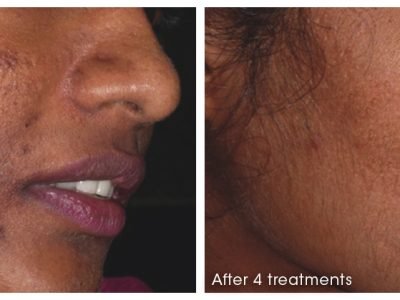 Dermaroller-HyperPigmentation-AcneScars-3-PRINT