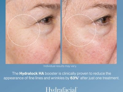 Hydralock Before After 2