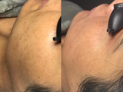 Illuminate after one treatment