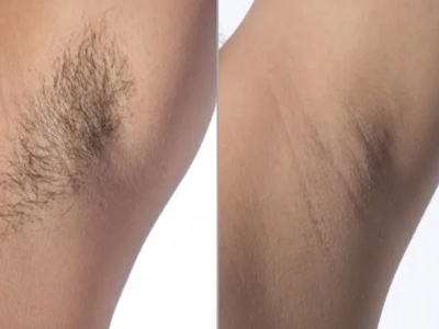before and after laser