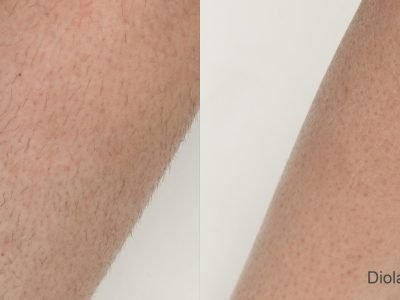 diolazexl-before-after-dr-j-diamond-preview-1