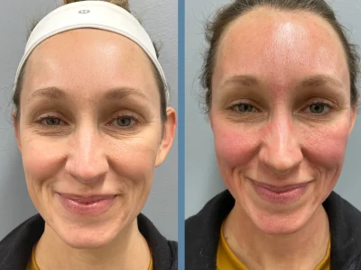 microneedling+b_a+2021