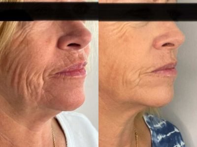 rf-microneedling-before-and-after-virtue-rf-skin-rejuvenation-3