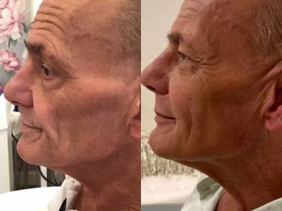 rf-microneedling-before-and-after-virtue-rf-skin-rejuvenation-6